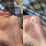 سيروم المسام الواسعة بالسالسيلك أسيد – Image 3