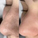 سيروم المسام الواسعة بالسالسيلك أسيد – Image 4