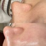 روتين حب الشباب و آثاره + المسام الواسعة – Image 8